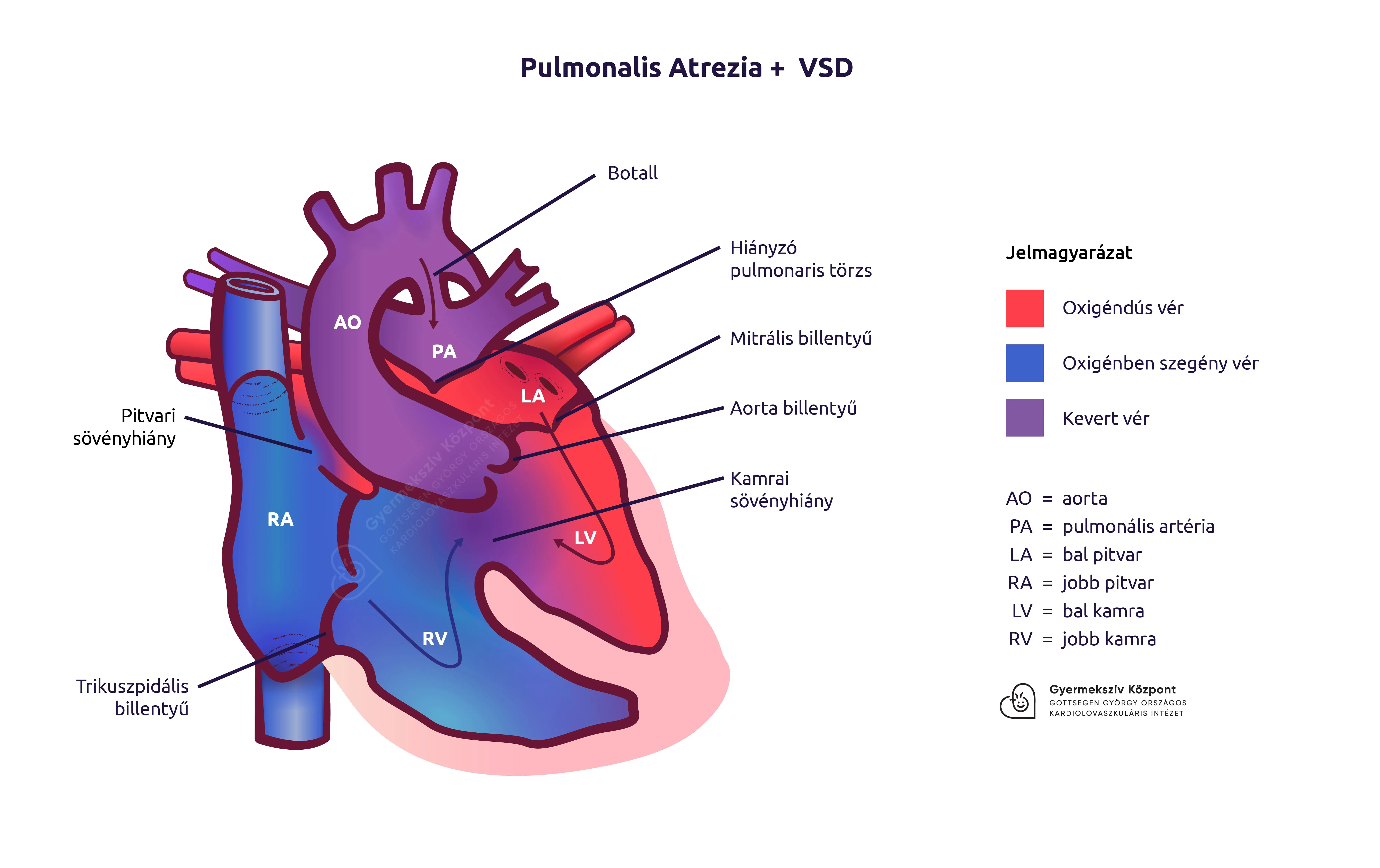 Pulmonalis atrezia + VSD